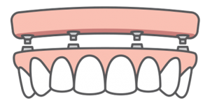 implant-supported denture illustration