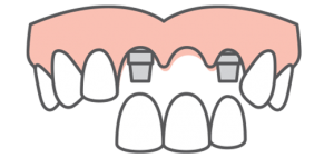 multi-tooth dental implants illustrations